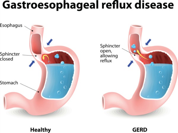 Gastroesophageal Reflux